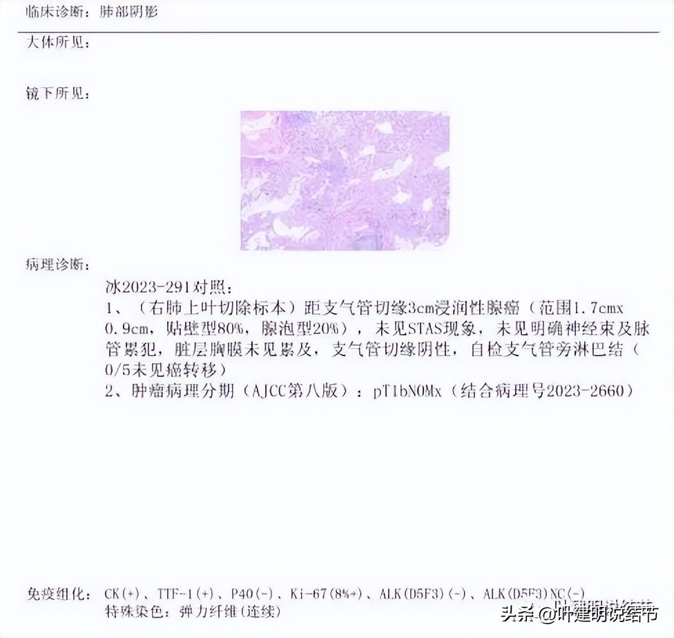 浙江肿瘤医院做肺结节手术多少钱,浙江省肿瘤医院肺结节微创手术