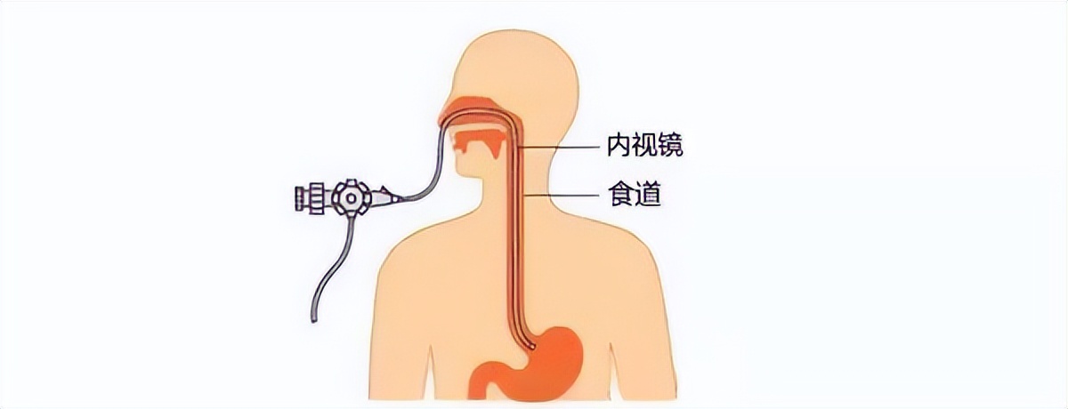 普通胃镜和无痛胃镜的区别是什么,普通胃镜和无痛胃镜的区别在哪里