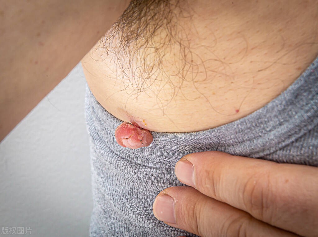 脖子上的小肉球可以自己消失吗,颈部小肉球那些事