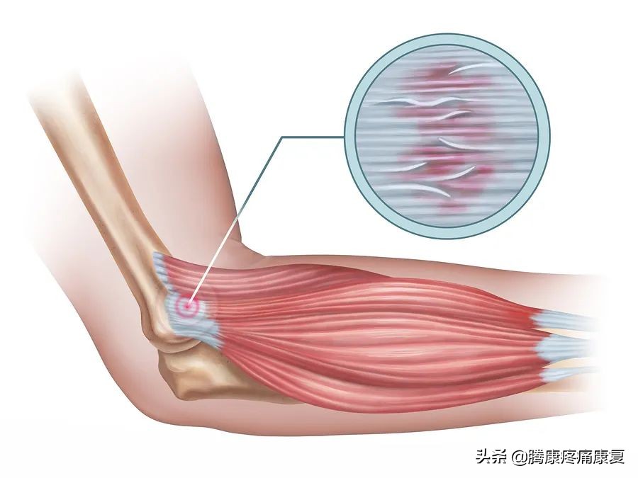 前臂桡侧疼痛怎么缓解,前臂疼痛按摩如何缓解