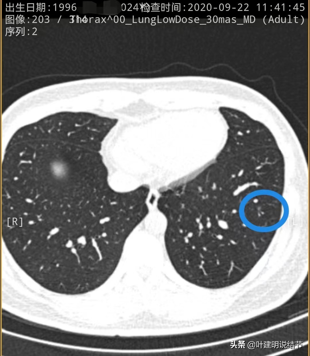 27岁女博士查出肺癌,年轻人多发肺结节怎么治愈