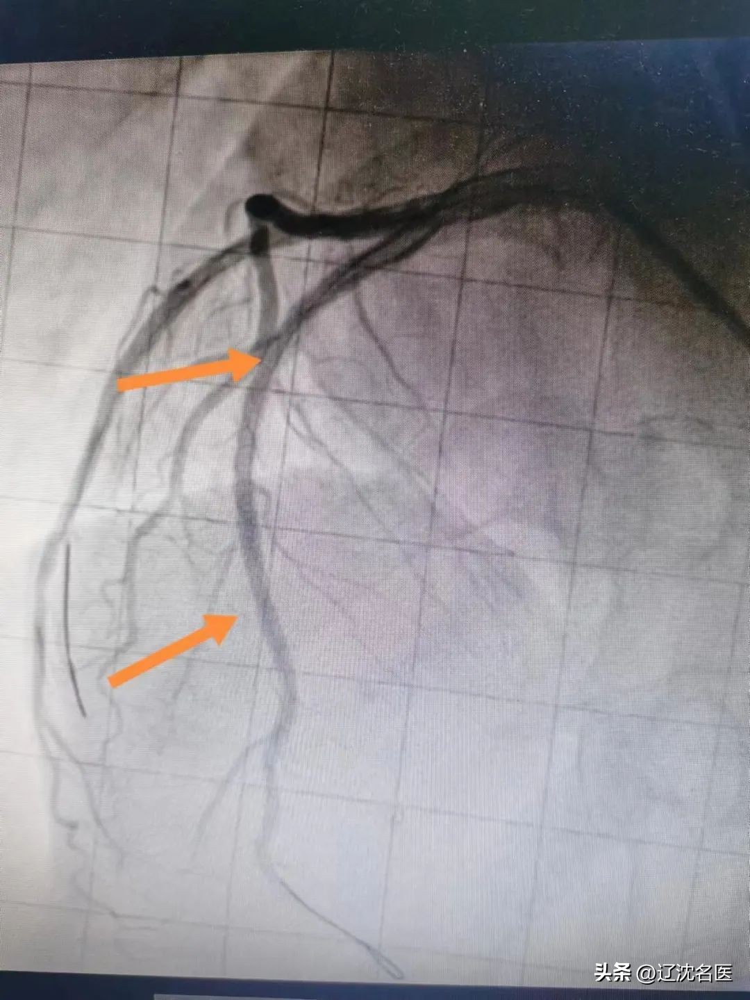 心脏长在右边，突发心梗咋救？！沈阳十院心脏中心救援纪实