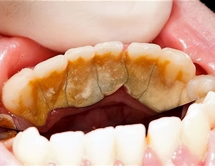 牙缝间牙结石怎样清除干净,牙缝表面的牙结石怎么洗掉