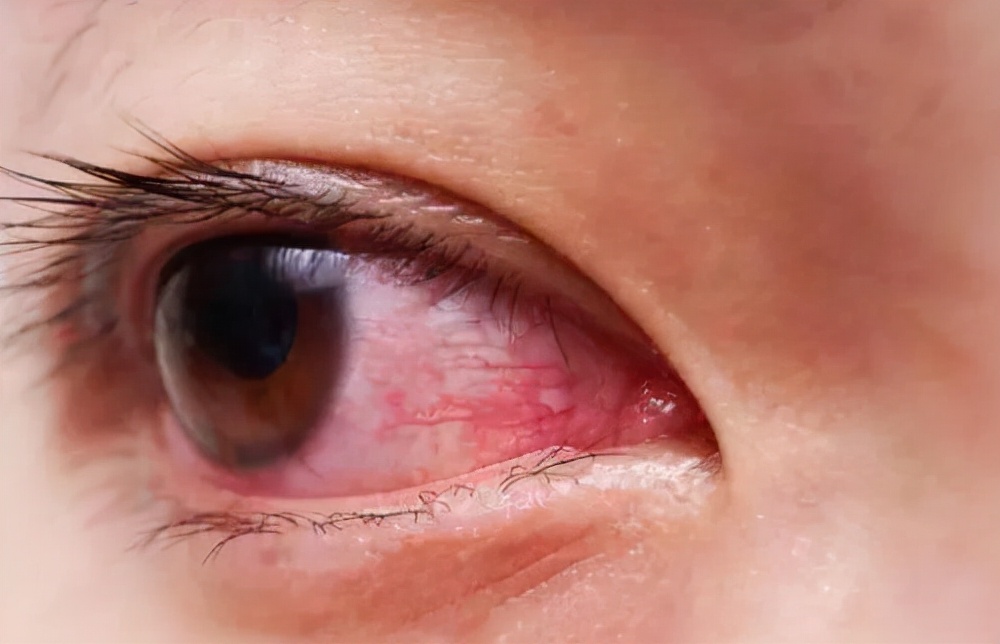 左眼皮或右眼皮跳有什么预兆,左眼皮上眼皮跳是好运还是厄运