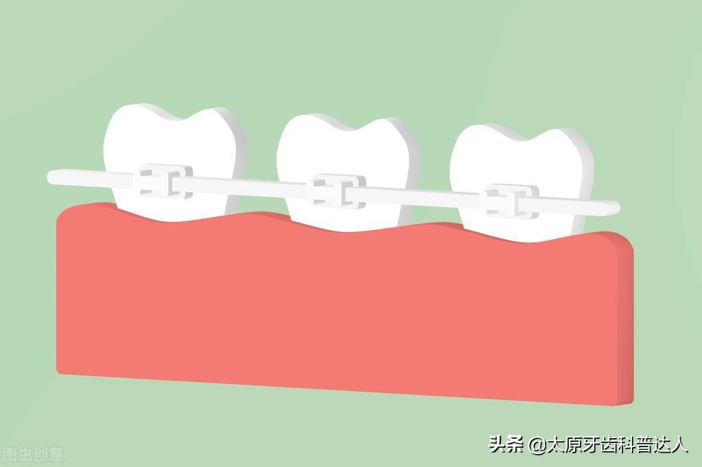 牙齿美容牙齿矫正时间如何缩短,牙齿矫正如何缩短矫正时间