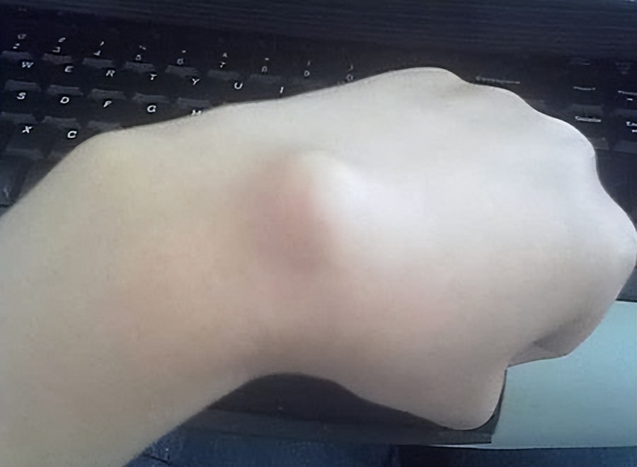 出了月子得了腱鞘炎,得了腱鞘炎该怎么办