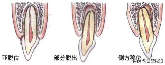 孩子换牙旧牙齿该怎么处理,小孩牙齿受伤换牙受影响吗