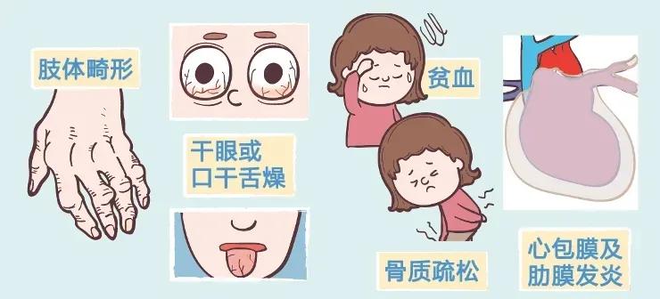 手指关节疼肿胀变形要警惕四种病,手指关节变形是风湿吗吃什么药