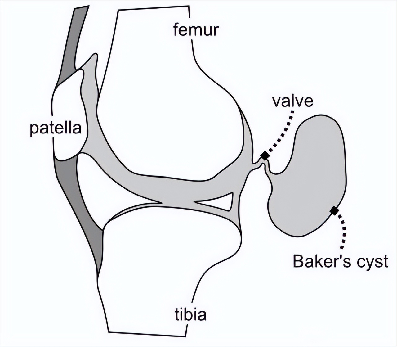 腿窝旁边起了一个鼓包是积液吗,腿左侧腘窝囊肿怎么治疗
