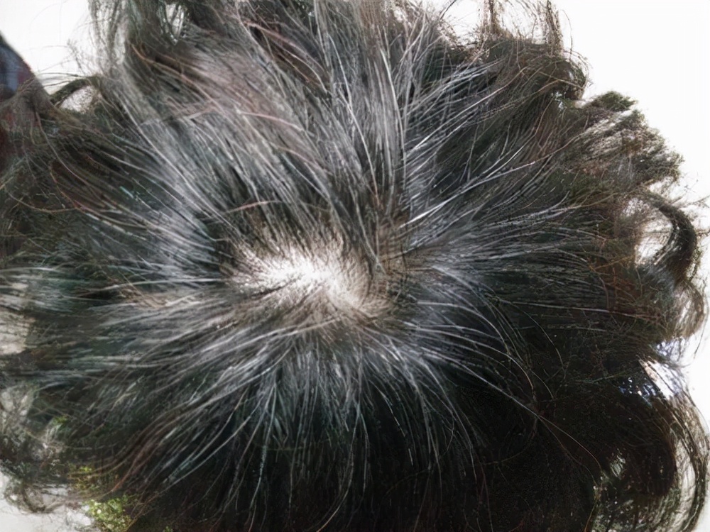 少白头遗传说法,怎么判断少白头是不是遗传的