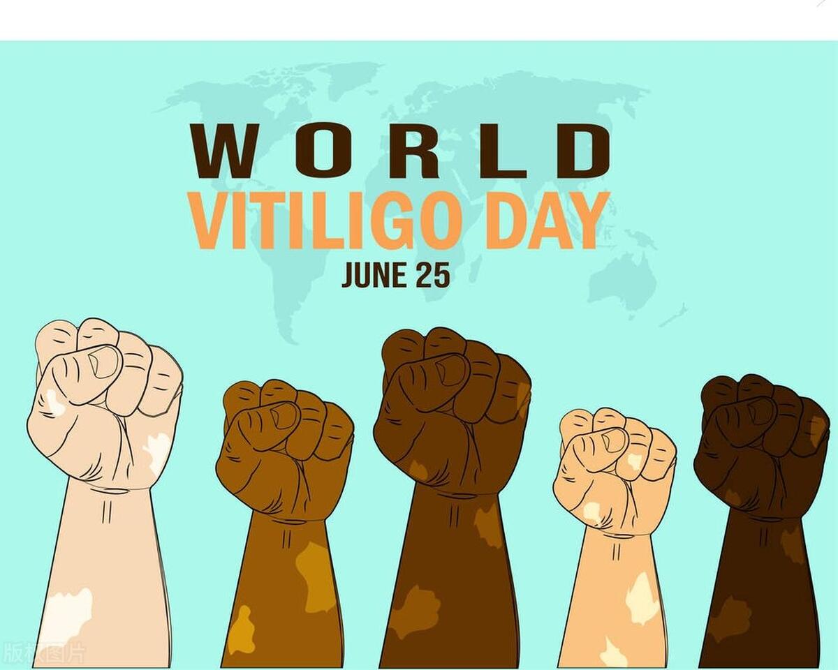 泛发性白癜风的症状有哪些特点,得了白癜风应该怎么治疗呢