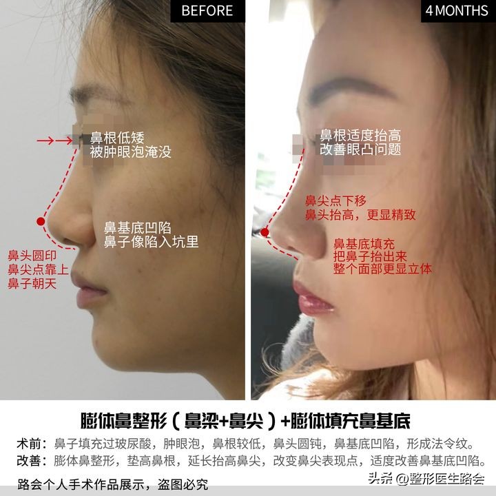 膨体隆鼻6年亲身经历,膨体隆鼻一年后的真实感言