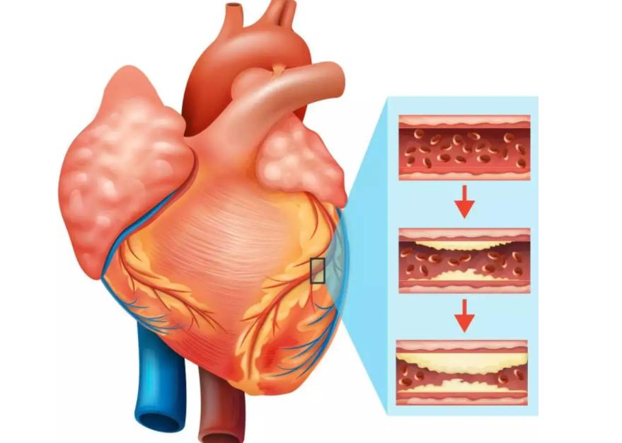 做完冠脉造影，病人就活不久了？冠脉造影检查对人体有什么危害？