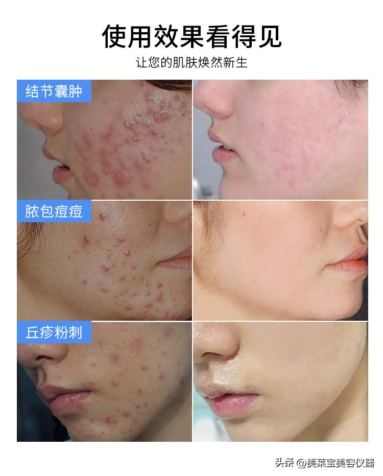 祛痘品牌代加工,祛痘产品代加工哪家好