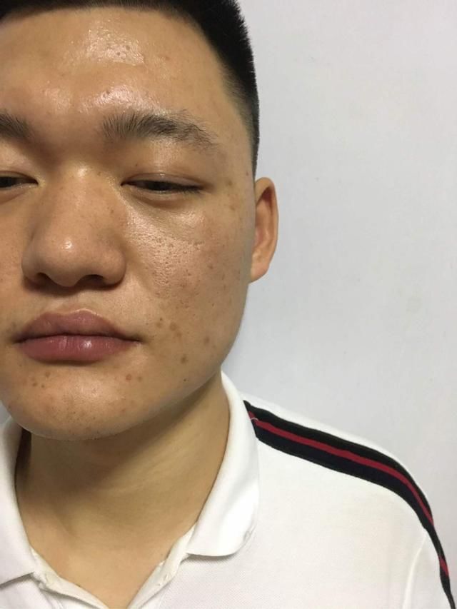 清洁面膜可以去黑头粉刺闭口吗,清洁面膜可以去除黑头吗