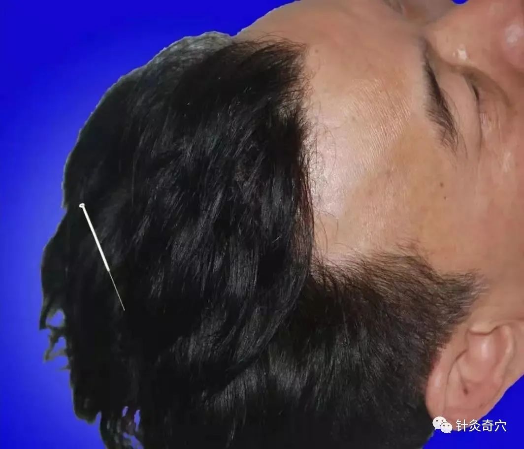 史上最全中医针灸视频教程全集,针灸治疗真实图片大全