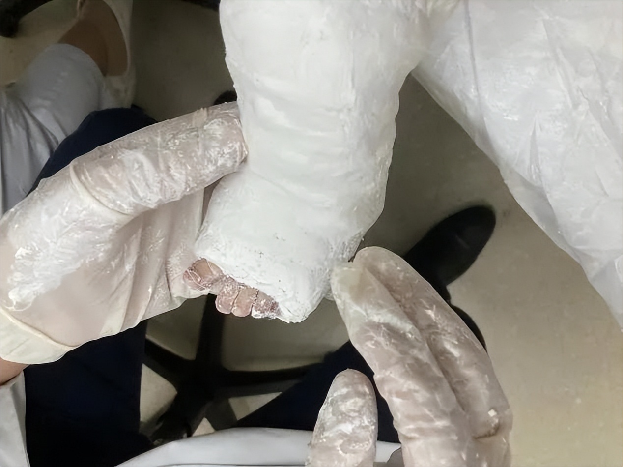 儿童股骨干粉碎性骨折对位不太好,儿童股骨干骨折石膏固定