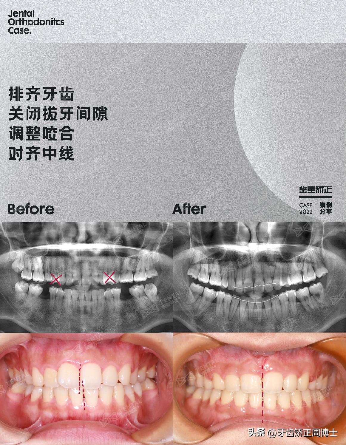 即刻种植即刻修复免受缺牙的痛苦,缺牙不补倾斜矫正价钱