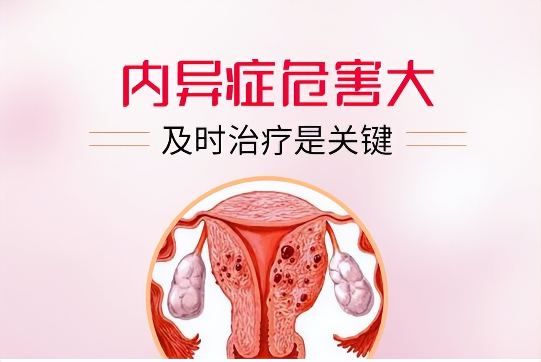 为什么会有子宫内膜异位症,为什么会得子宫内膜异位症