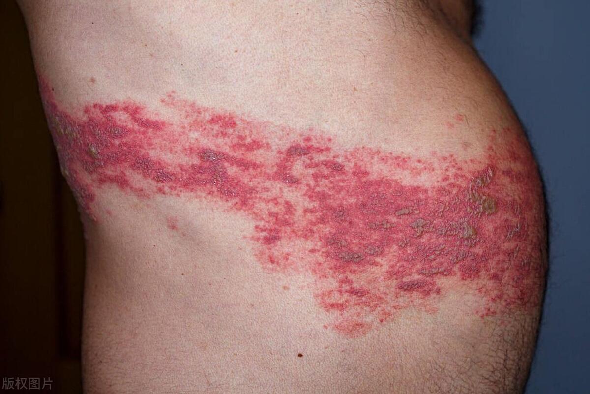 艾滋病不是病,有艾滋病的所有症状又是艾滋病吗