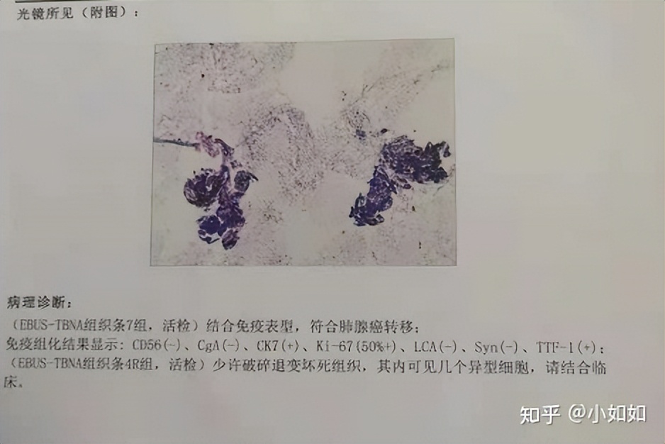 确诊肺腺癌四期,爸爸确诊肺腺癌晚期