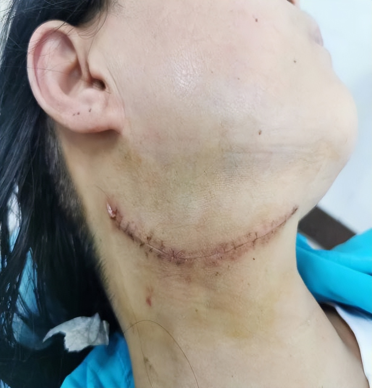 微创口腔颌面肿瘤,口腔颌面切除