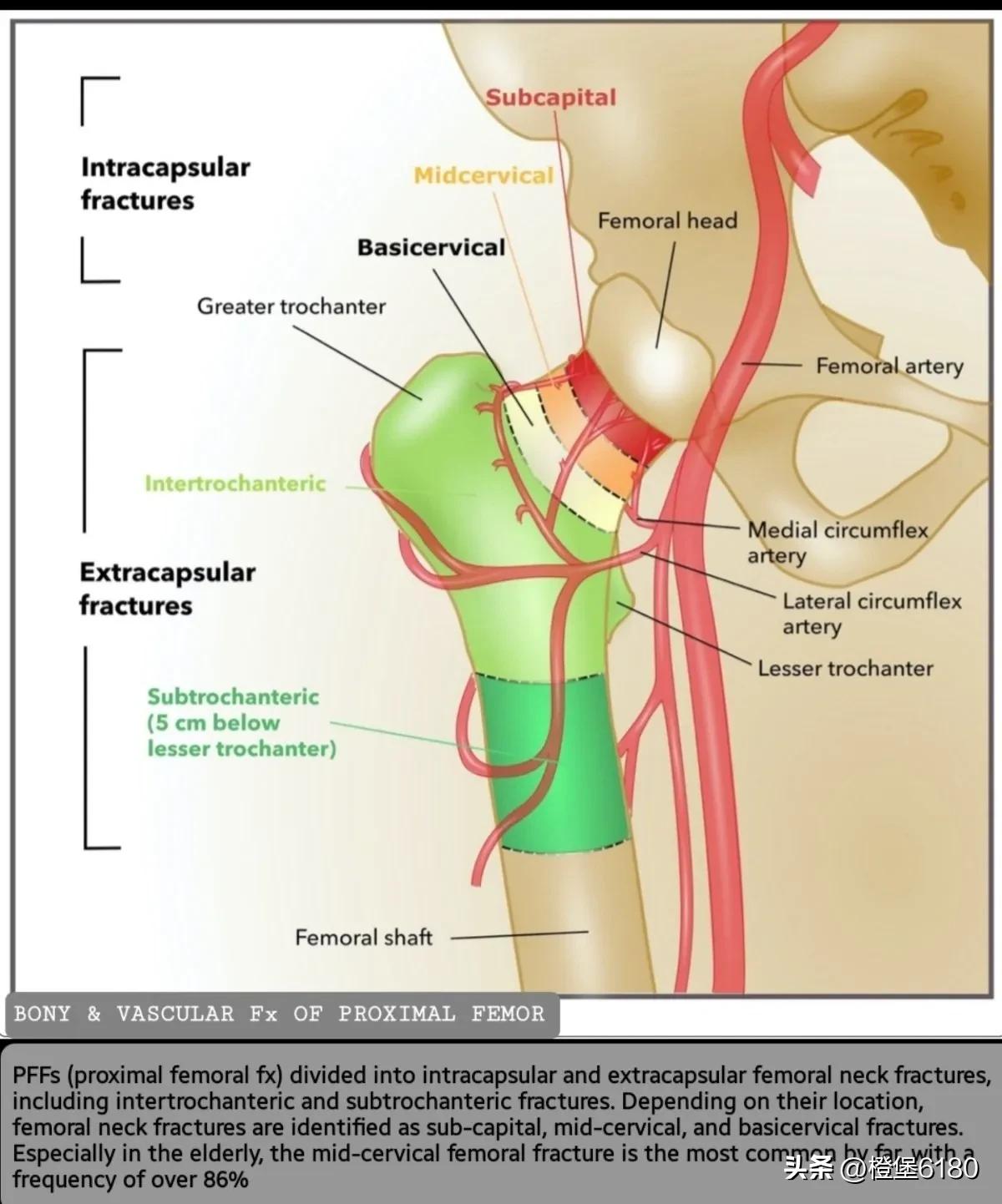 股骨转子间骨折pfna手术记录,股骨骨折mri