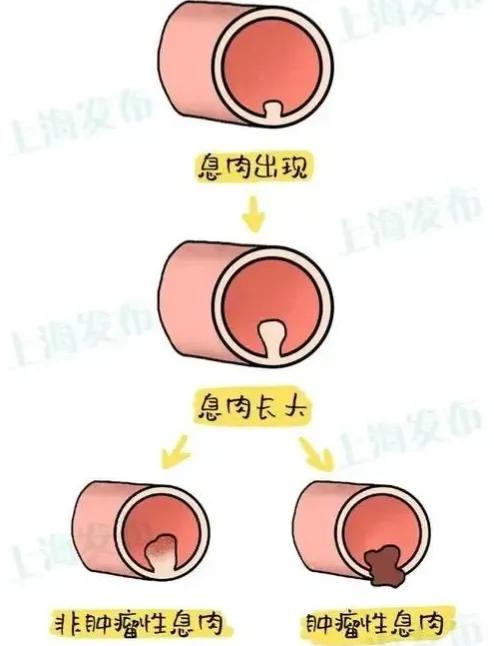 肠长了息肉会有啥症状,肠内为什么容易长息肉