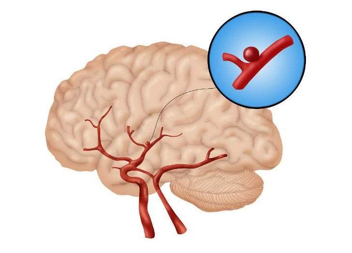 高血压轻微脑出血引起脚麻痹无力,高血压脑出血一侧身体麻木怎么办