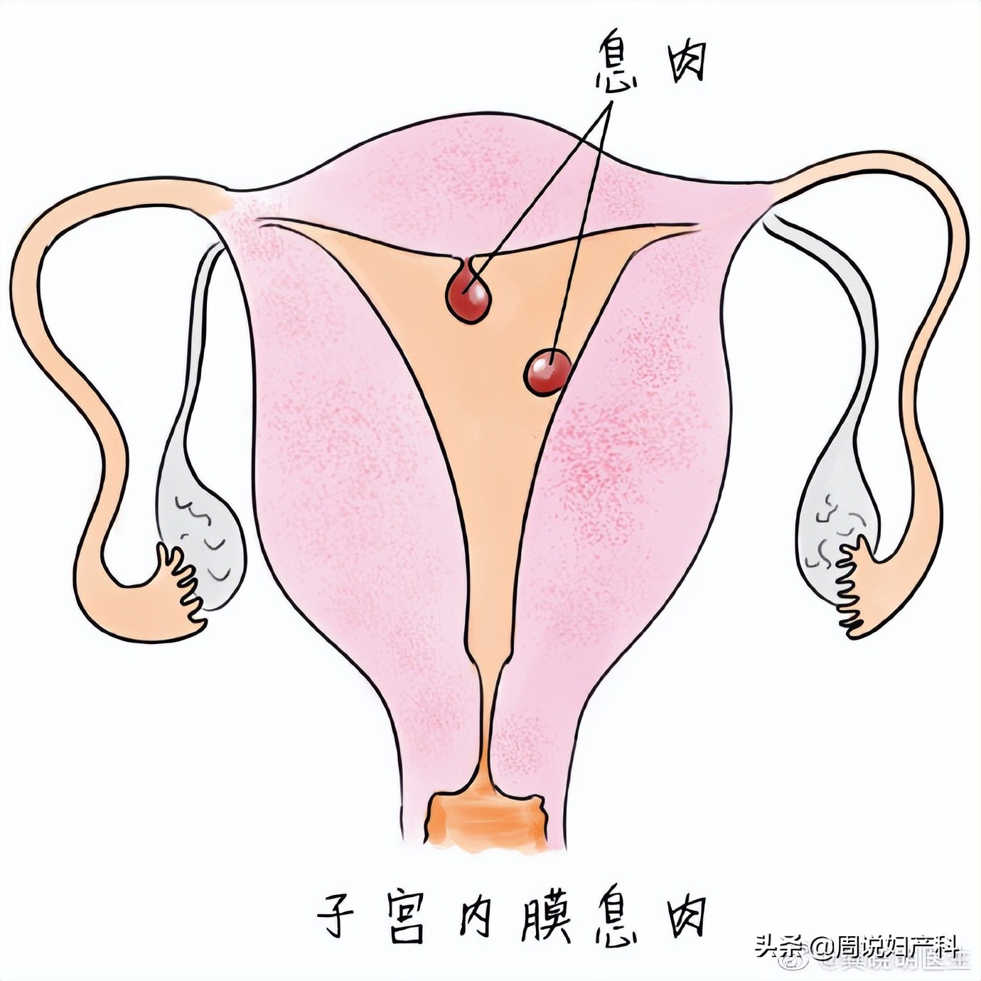 子宫息肉做宫腔镜手术需要多少钱,子宫里面为什么会长息肉