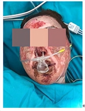 重度烧伤80%皮肤修复,皮肤烧伤的女孩后续