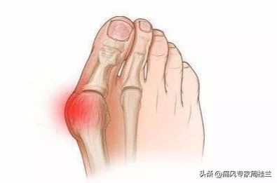 痛风立竿见影的止痛药,痛风药30分钟见效