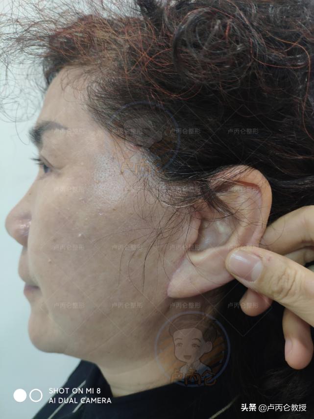 拉皮除皱手术有哪些,拉皮除皱手术的危害