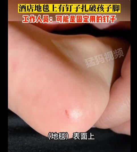 钉子扎脚丫,小男孩的脚被钉子扎穿了