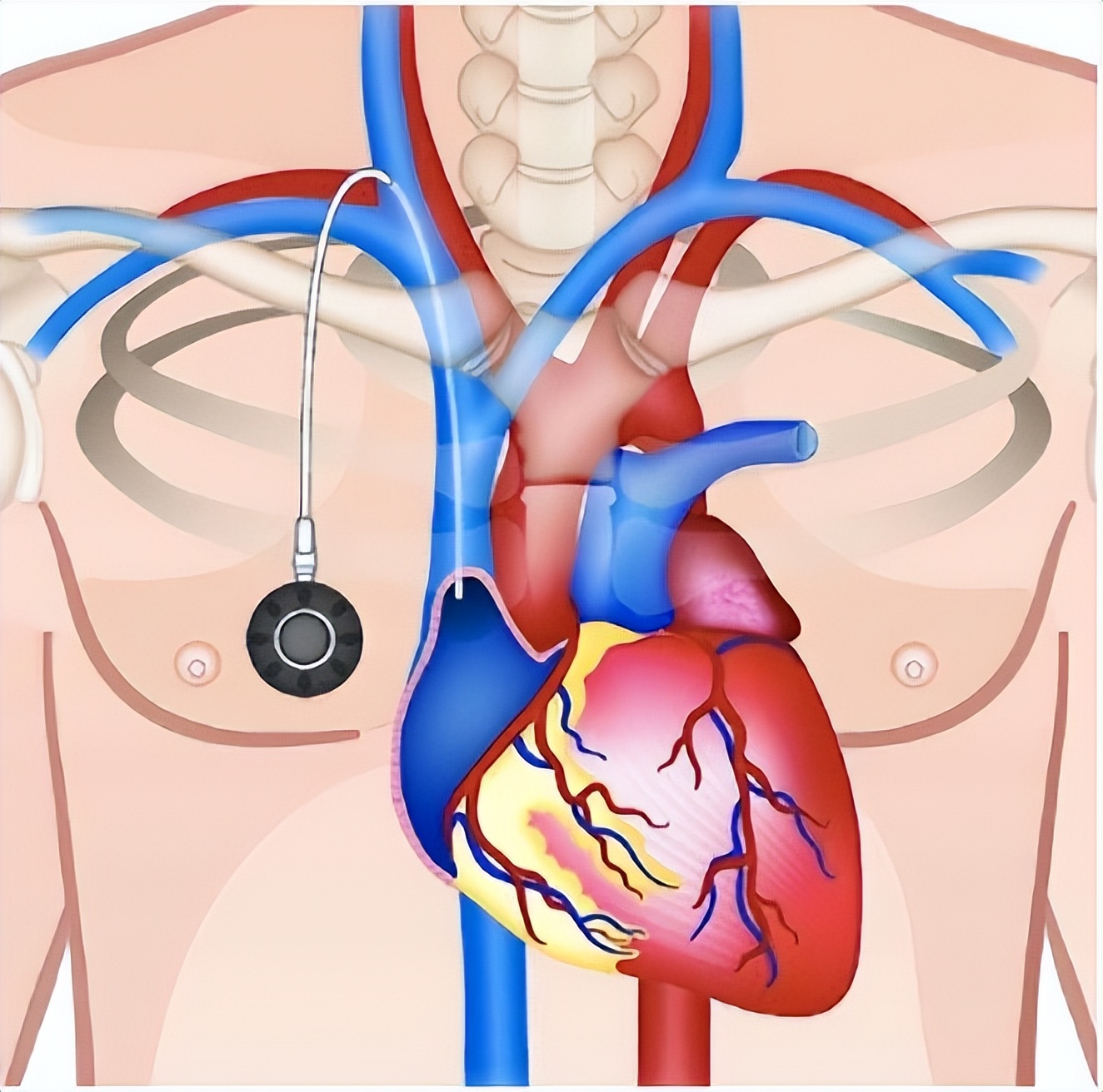 癌症病人输液港是什么,输液港对癌症有什么危害
