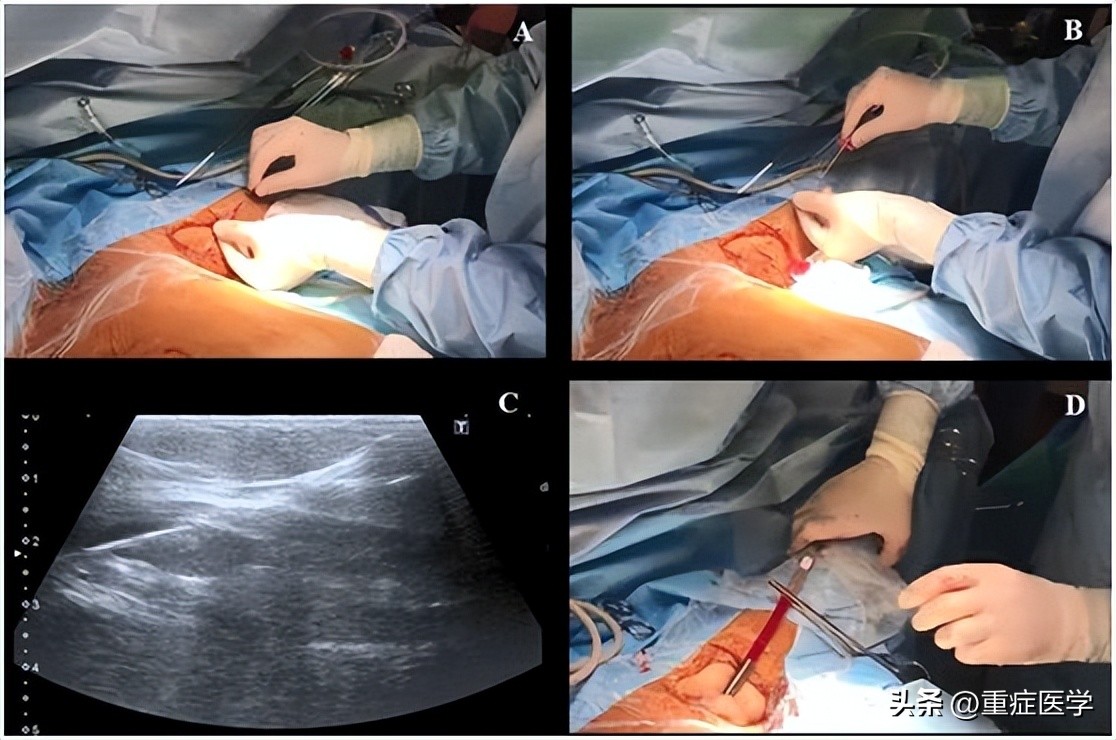 超声引导锁骨下静脉穿刺置管术,超声引导下腋静脉穿刺技巧