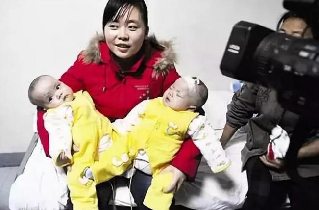 中国首例坐骨连体婴,坐骨连体姐妹分离成功了吗