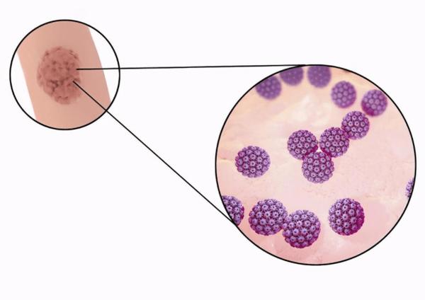 警惕！身上5种疣跟HPV病毒有关！