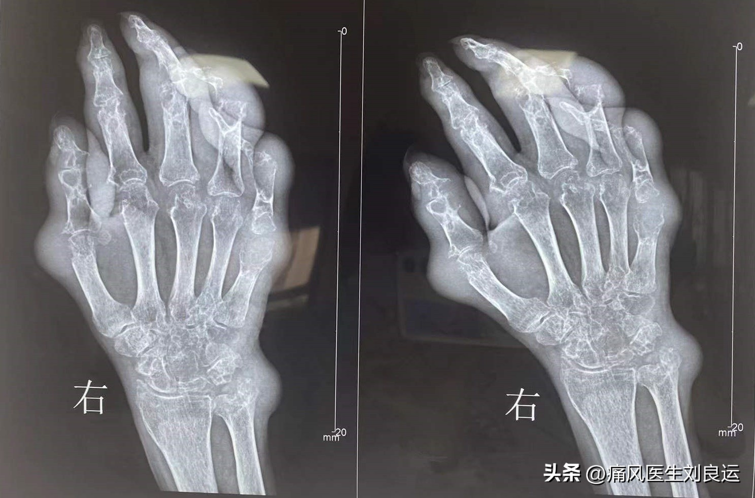 痛风男性千万别吃三种蔬菜,男子痛风长期吃止痛药