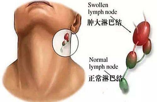 8岁男孩查出肾衰竭,肾衰竭患者亲身经历