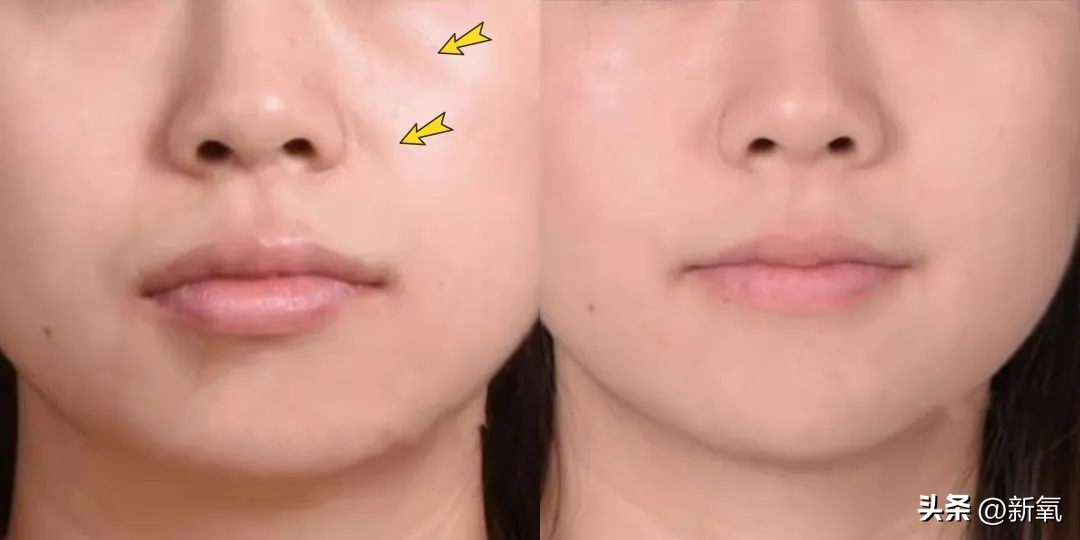 牙齿正畸和骨骼正畸的区别,牙齿正畸和眼轴增长有关系吗