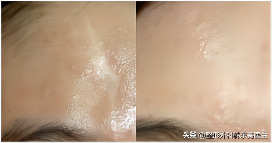 脸部疤痕最好的修复方法,修复凹陷疤痕的最好方法