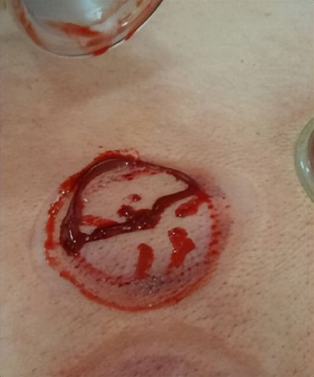 名医面对面丨夏立君：经常熬夜、酗酒，当心“玫瑰*疮痤**”！