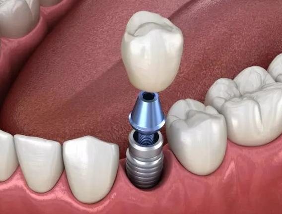 缺牙时间久镶牙位置不够怎么办,缺牙太久局部矫正