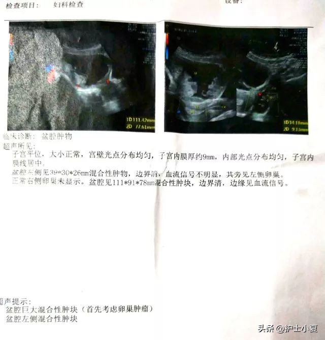 卵巢肿瘤与胃的关系,卵巢恶性肿瘤胃疼