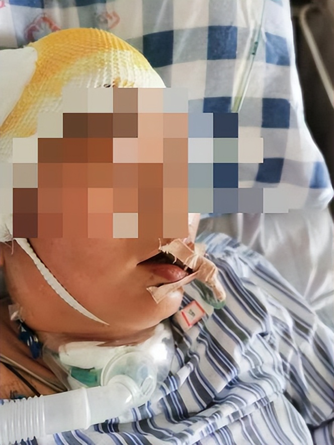 医院成功救治重型颅脑患者,特重型颅脑损伤治愈案