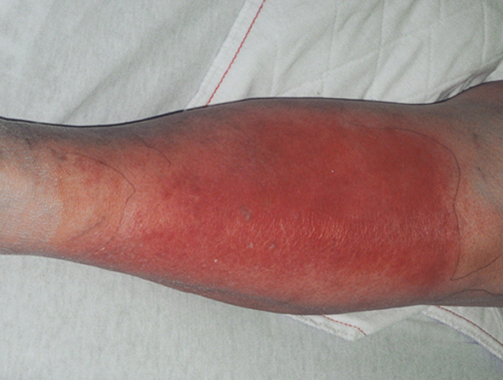 所有的灰指甲,灰指甲的危害到底有多大