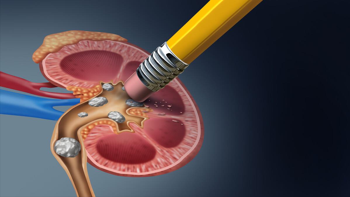 好好的人,为什么会得肾积水?严重患者,能保住肾脏吗?涨知识了