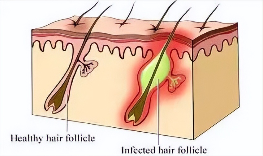 背后长了好多痘痘是性病吗,脖子下面长痘痘是性病吗