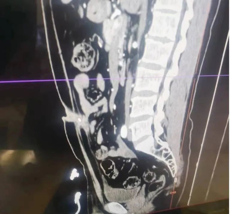 隆回县人民医院:患者身上怪味从何来?原来是“脐膀胱瘘”在作怪